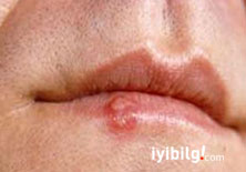 U&ccedil;uk vir&uuml;s&uuml; ile Alzheimer aras�nda ba�lant�